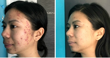 photo of before and aftrer cosmetic acupuncture treatment