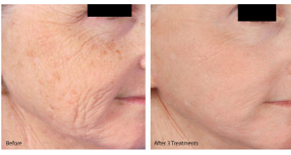 before and after facial rejuvenation treatment