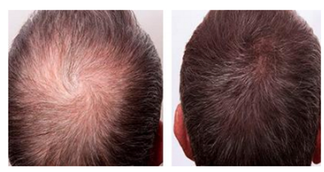 before and after photos for cosmetic acupuncture treatment for hair loss